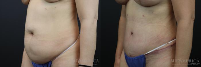 Before & After Tummy Tuck Case 169 View #2 View in St. Louis, MO