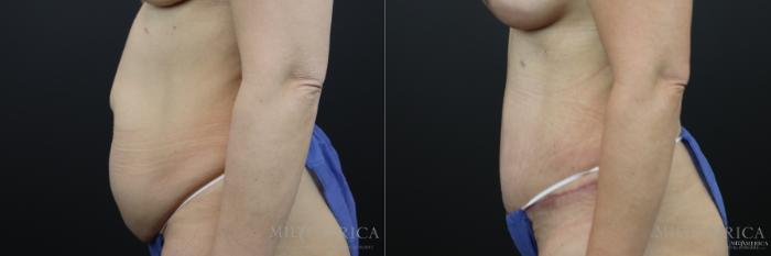 Before & After Tummy Tuck Case 169 View #3 View in St. Louis, MO