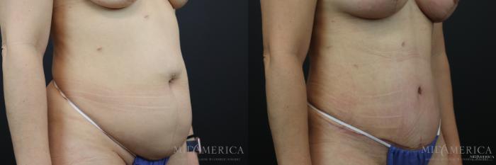 Before & After Tummy Tuck Case 169 View #4 View in St. Louis, MO