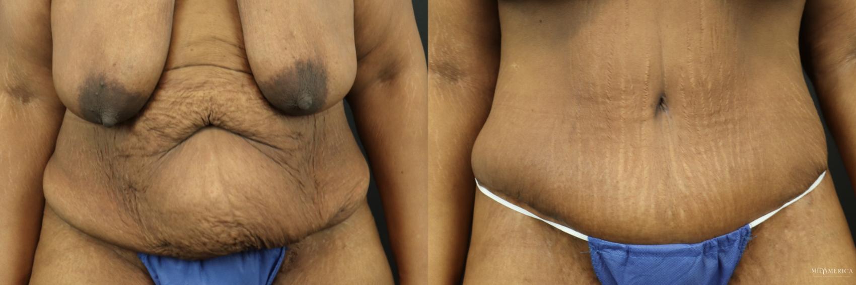 Before & After Tummy Tuck Case 201 Front View in St. Louis, MO
