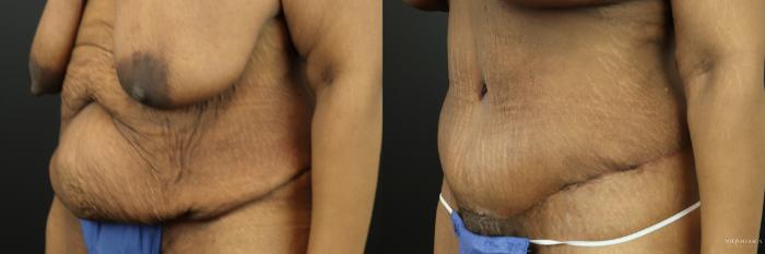 Before & After Tummy Tuck Case 201 Left Oblique View in St. Louis, MO