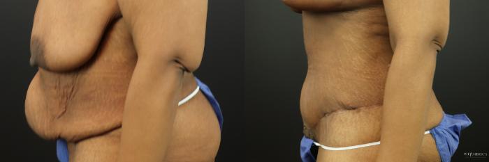 Before & After Tummy Tuck Case 201 Left Side View in St. Louis, MO