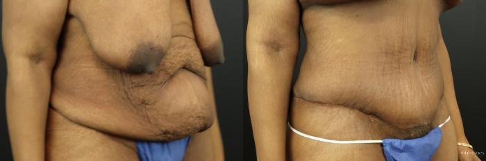 Before & After Tummy Tuck Case 201 Right Oblique View in St. Louis, MO