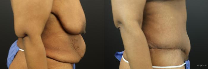 Before & After Tummy Tuck Case 201 Right Side View in St. Louis, MO