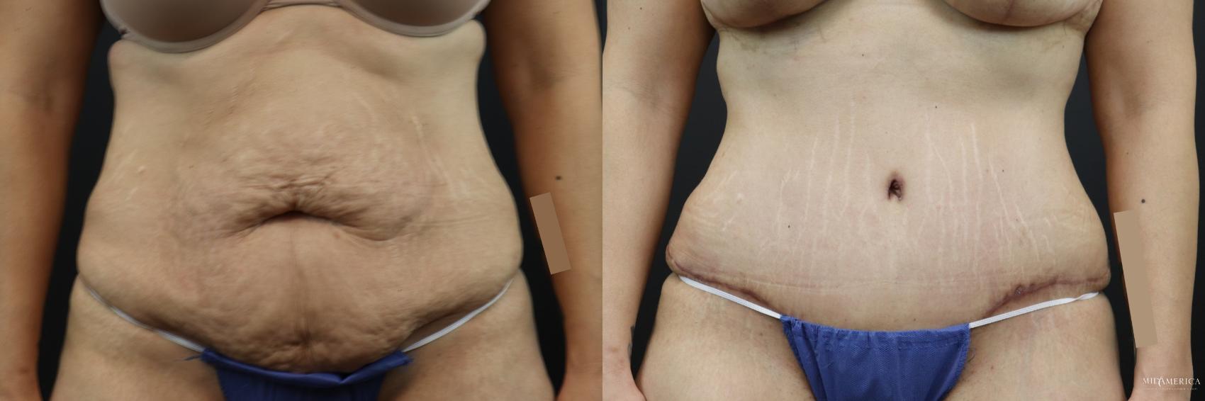 Before & After Tummy Tuck Case 207 Front View in St. Louis, MO