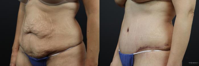 Before & After Tummy Tuck Case 207 Left Oblique View in St. Louis, MO