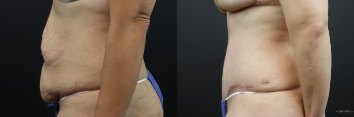 Before & After Tummy Tuck Case 207 Left Side View in St. Louis, MO