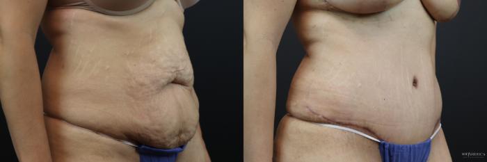 Before & After Tummy Tuck Case 207 Right Oblique View in St. Louis, MO