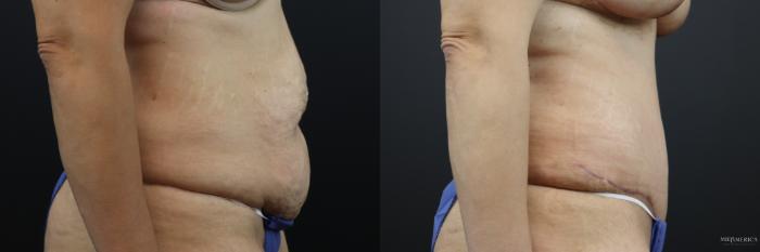 Before & After Tummy Tuck Case 207 Right Side View in St. Louis, MO