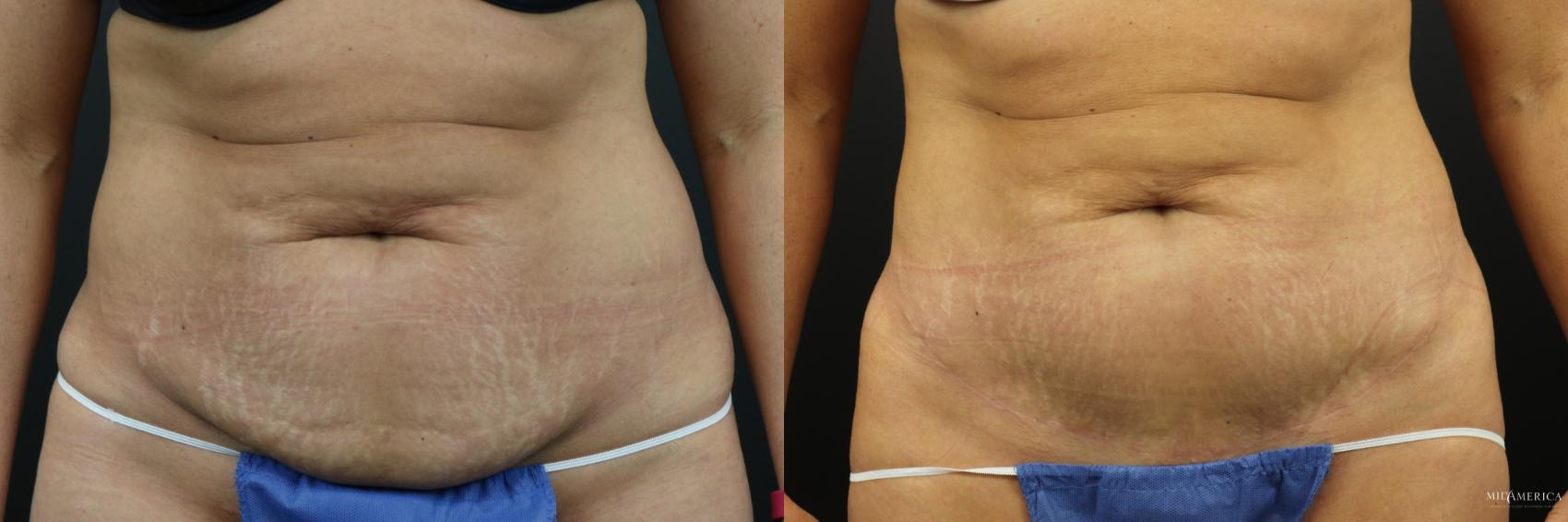 Before & After Tummy Tuck Case 224 Front View in St. Louis, MO