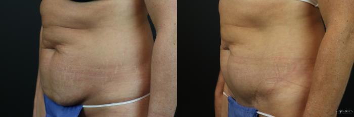 Before & After Tummy Tuck Case 224 Left Oblique View in St. Louis, MO