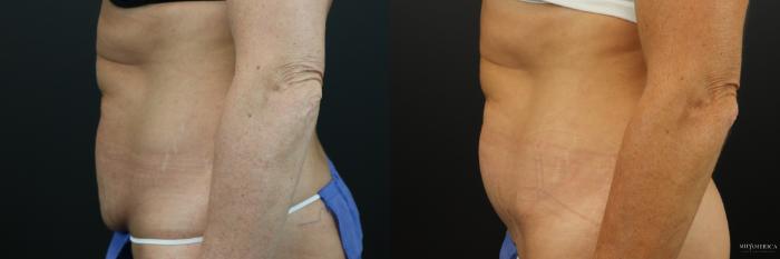 Before & After Tummy Tuck Case 224 Left Side View in St. Louis, MO