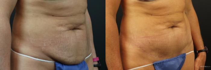 Before & After Tummy Tuck Case 224 Right Oblique View in St. Louis, MO