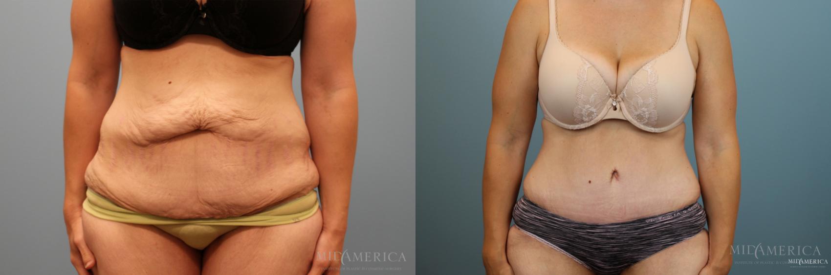 Before & After Tummy Tuck Case 23 View #1 View in Glen Carbon, IL