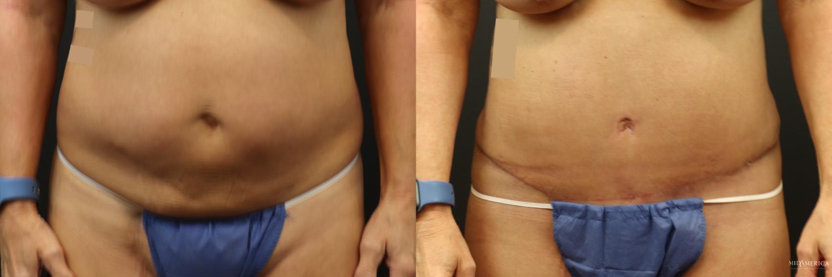 Before & After Liposuction Case 233 Front View in Glen Carbon, IL