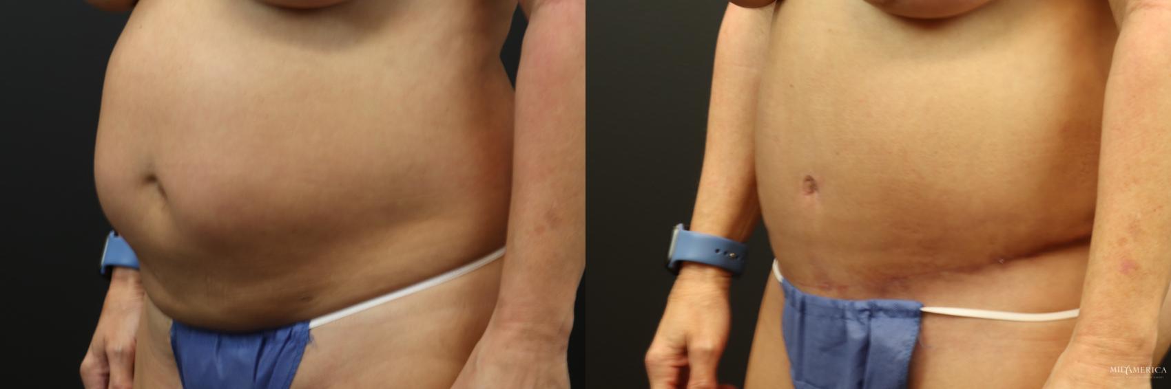 Before & After Tummy Tuck Case 233 Left Oblique View in Glen Carbon, IL