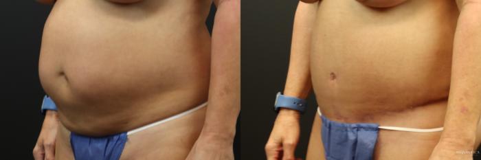 Before & After Tummy Tuck Case 233 Left Oblique View in St. Louis, MO