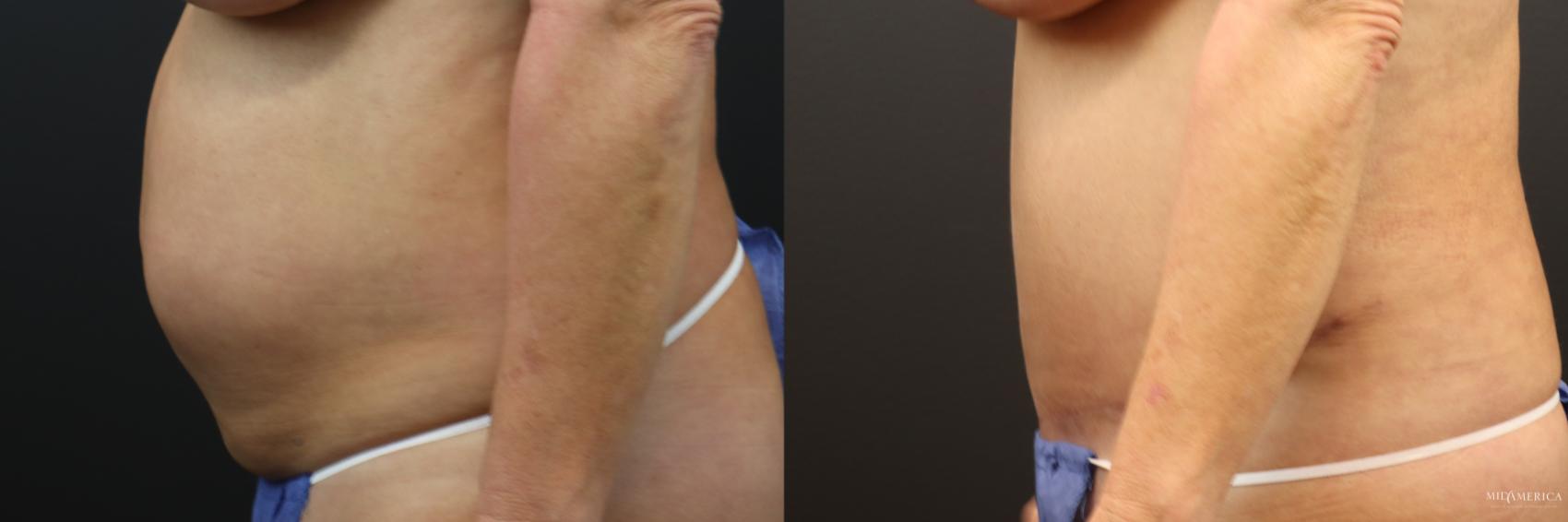 Before & After Tummy Tuck Case 233 Left Side View in Glen Carbon, IL