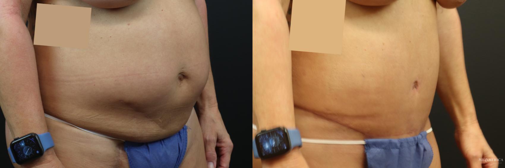 Before & After Tummy Tuck Case 233 Right Oblique View in Glen Carbon, IL