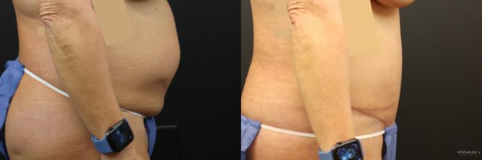 Before & After Tummy Tuck Case 233 Right Side View in St. Louis, MO