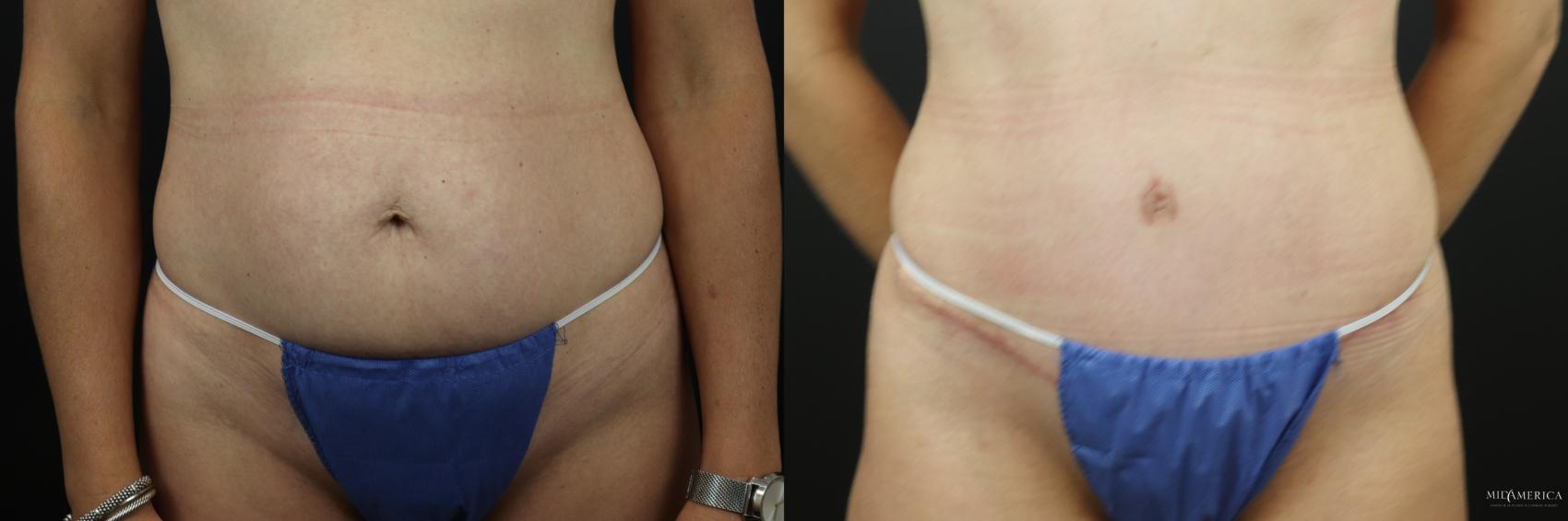 Before & After Tummy Tuck Case 238 Front View in St. Louis, MO