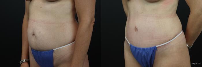 Before & After Tummy Tuck Case 238 Left Oblique View in St. Louis, MO