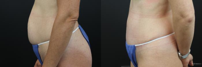 Before & After Tummy Tuck Case 238 Left Side View in St. Louis, MO
