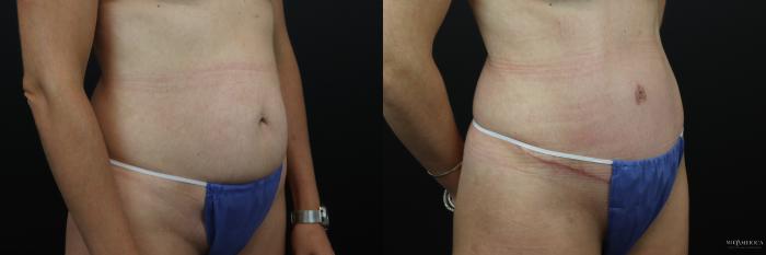 Before & After Tummy Tuck Case 238 Right Oblique View in St. Louis, MO
