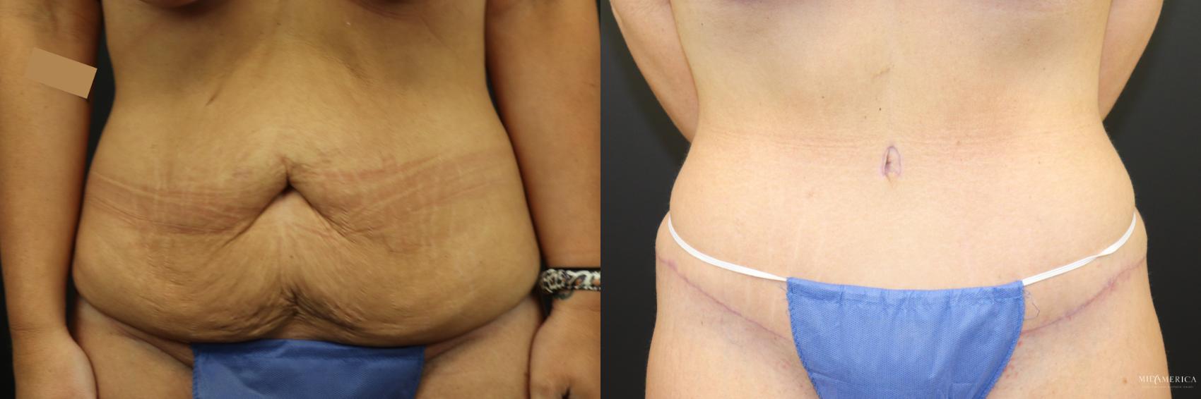 Before & After Tummy Tuck Case 241 Front View in Glen Carbon, IL