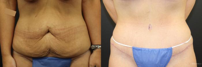 Before & After Tummy Tuck Case 241 Front View in St. Louis, MO