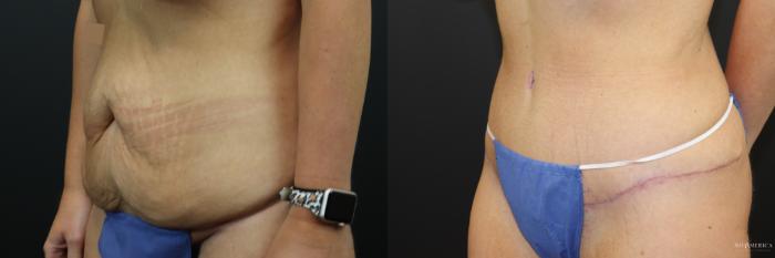 Before & After Tummy Tuck Case 241 Left Oblique View in St. Louis, MO