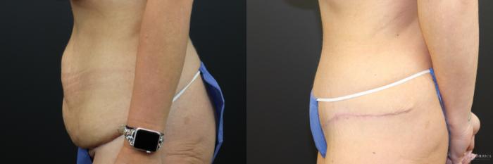 Before & After Tummy Tuck Case 241 Left Side View in St. Louis, MO