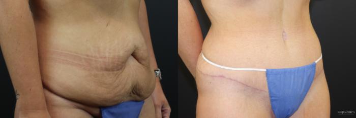 Before & After Tummy Tuck Case 241 Right Oblique View in St. Louis, MO