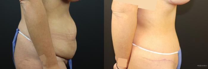 Before & After Tummy Tuck Case 241 Right Side View in St. Louis, MO