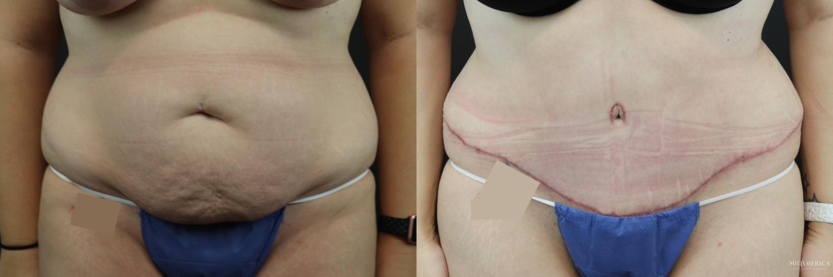Before & After Tummy Tuck Case 248 Front View in Glen Carbon, IL