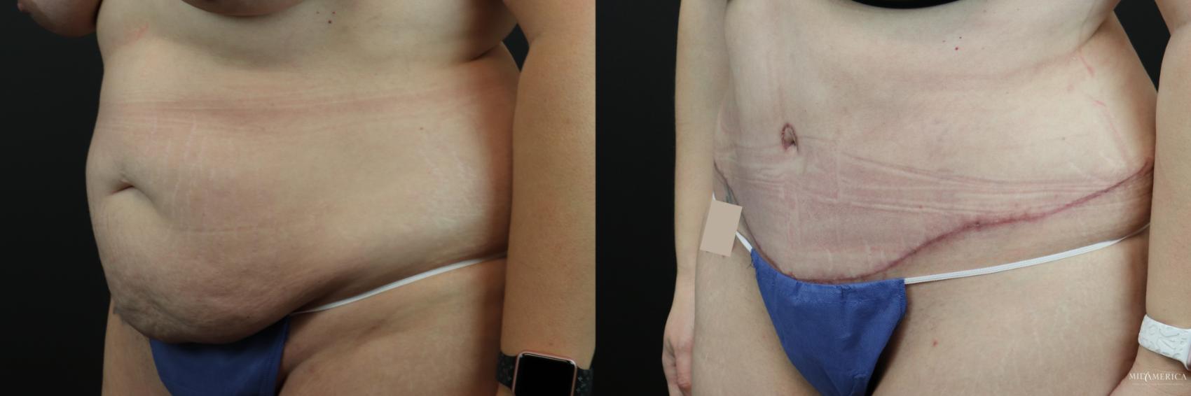 Before & After Tummy Tuck Case 248 Left Oblique View in Glen Carbon, IL