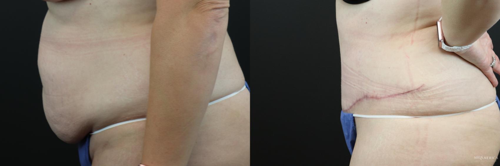 Before & After Tummy Tuck Case 248 Left Side View in Glen Carbon, IL