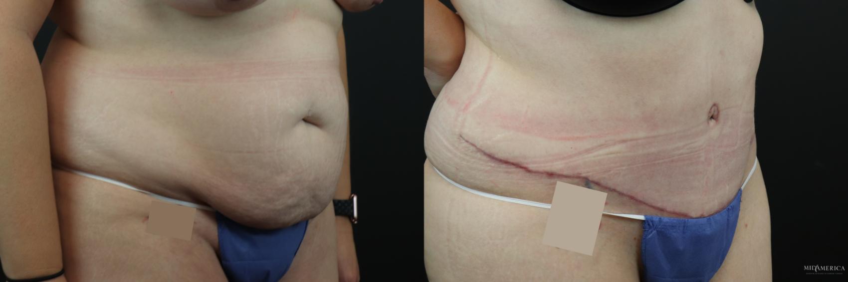 Before & After Tummy Tuck Case 248 Right Oblique View in Glen Carbon, IL