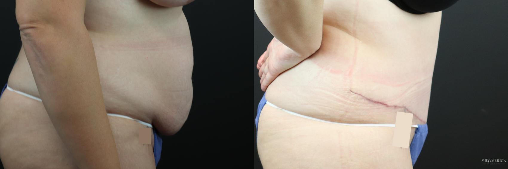 Before & After Tummy Tuck Case 248 Right Side View in Glen Carbon, IL