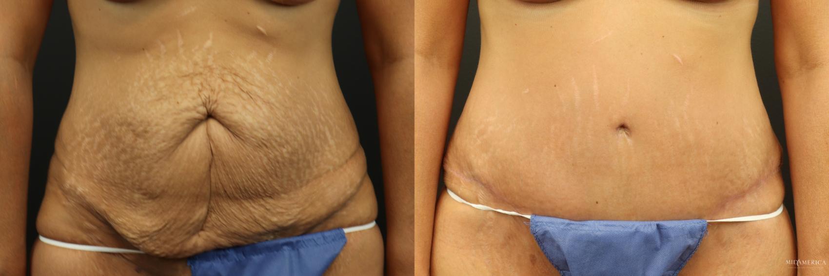 Before & After Tummy Tuck Case 253 Front View in Glen Carbon, IL
