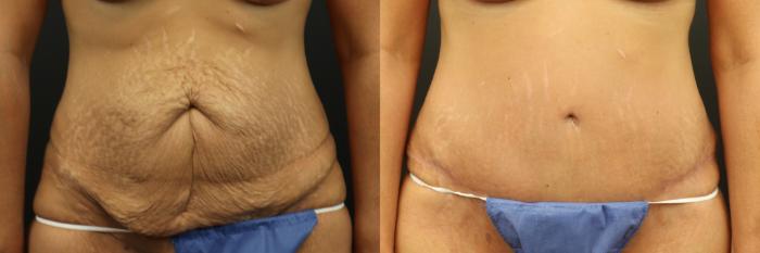 Before & After Tummy Tuck Case 253 Front View in St. Louis, MO