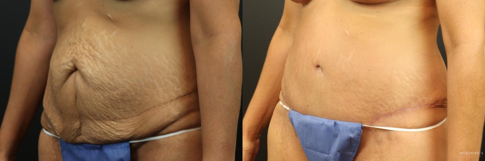 Before & After Tummy Tuck Case 253 Left Oblique View in Glen Carbon, IL