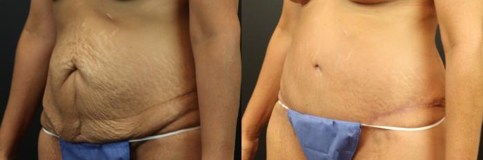 Before & After Tummy Tuck Case 253 Left Oblique View in St. Louis, MO