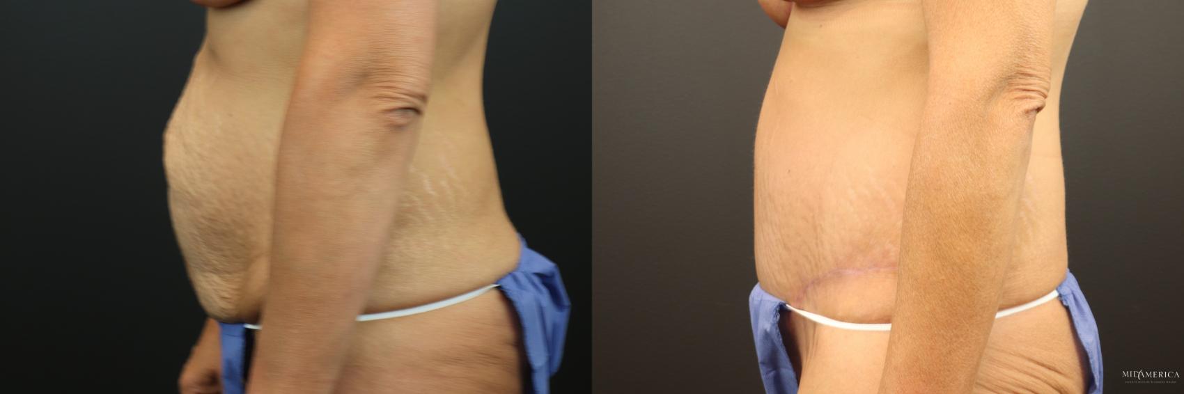 Before & After Tummy Tuck Case 253 Left Side View in Glen Carbon, IL
