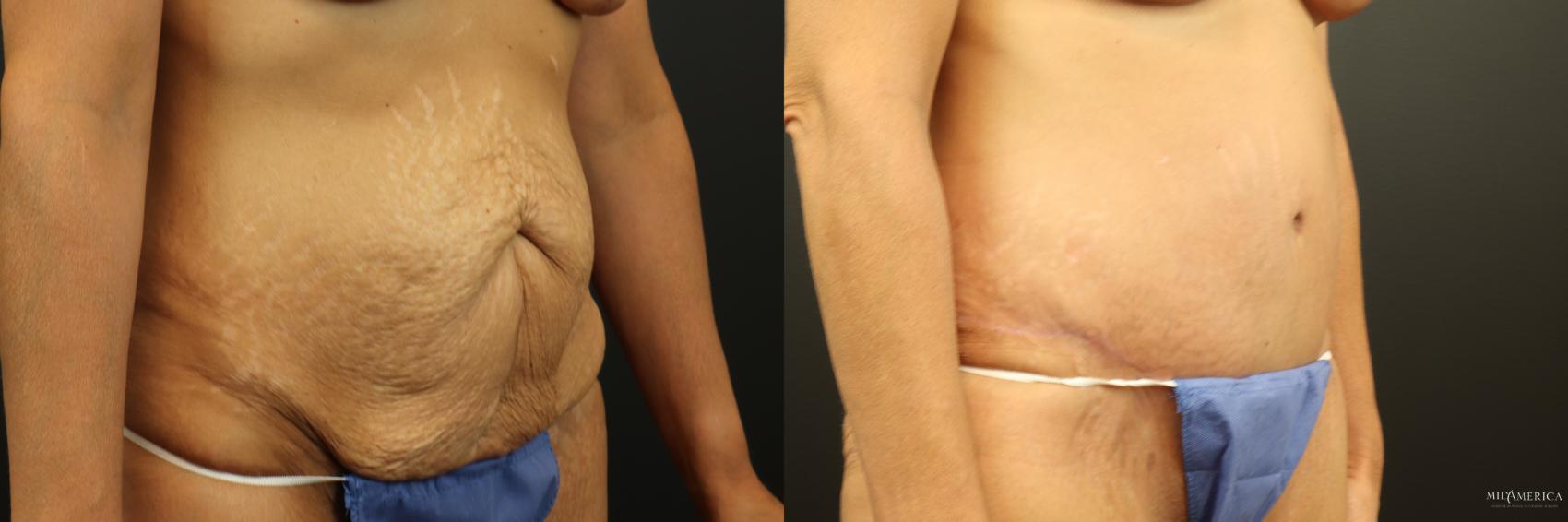 Before & After Tummy Tuck Case 253 Right Oblique View in Glen Carbon, IL
