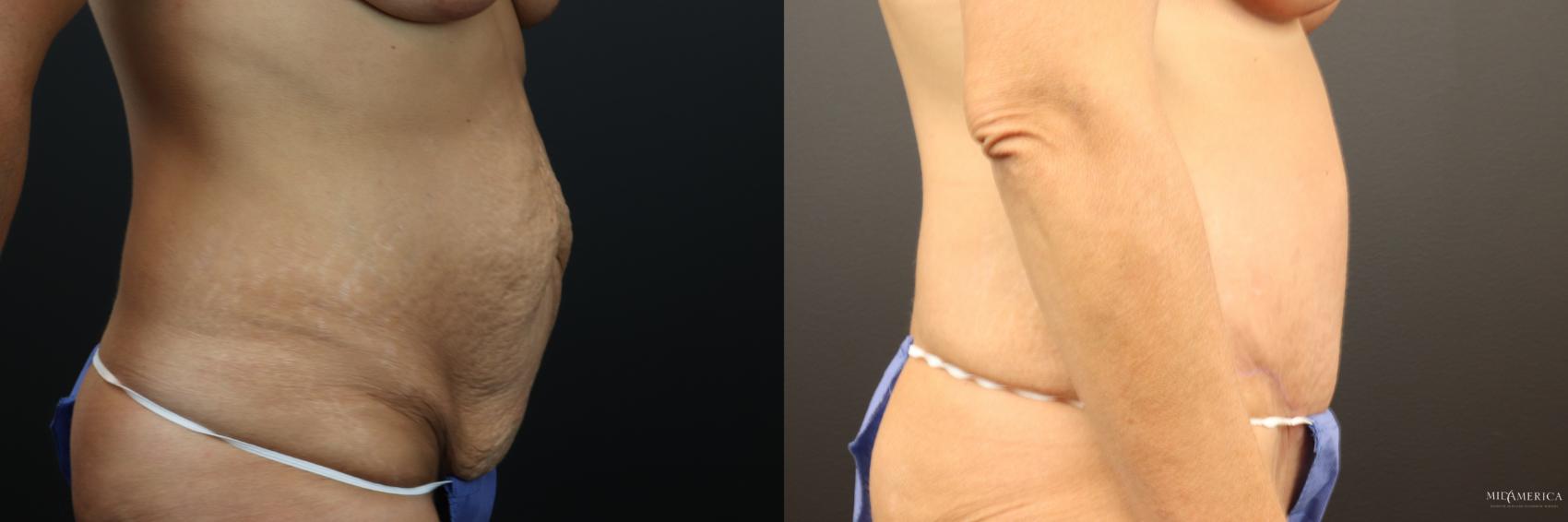 Before & After Tummy Tuck Case 253 Right Side View in Glen Carbon, IL