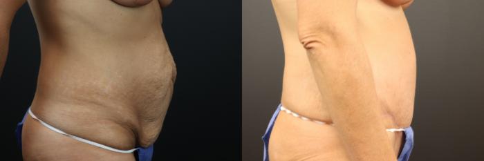 Before & After Tummy Tuck Case 253 Right Side View in St. Louis, MO