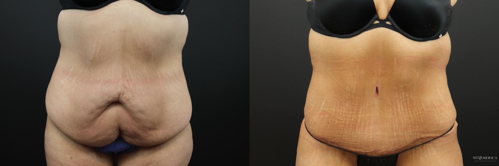 Before & After Tummy Tuck Case 257 Front View in Glen Carbon, IL