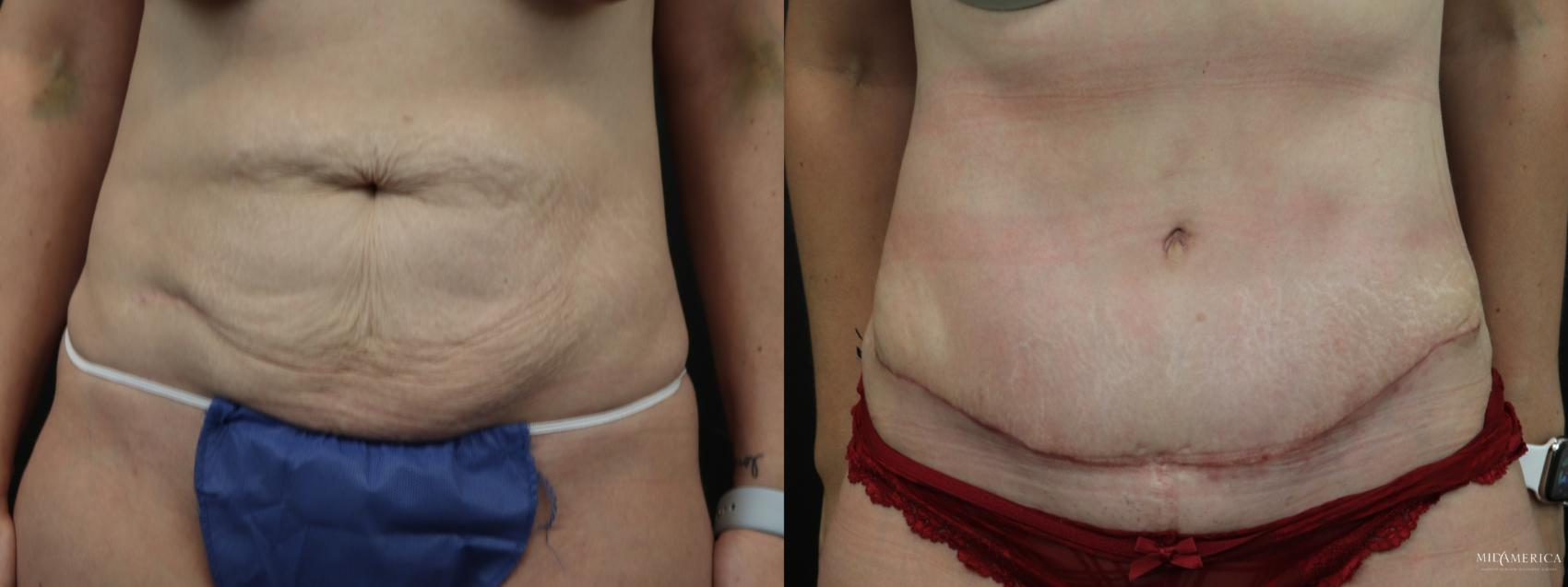 Before & After Tummy Tuck Case 262 Front View in Glen Carbon, IL