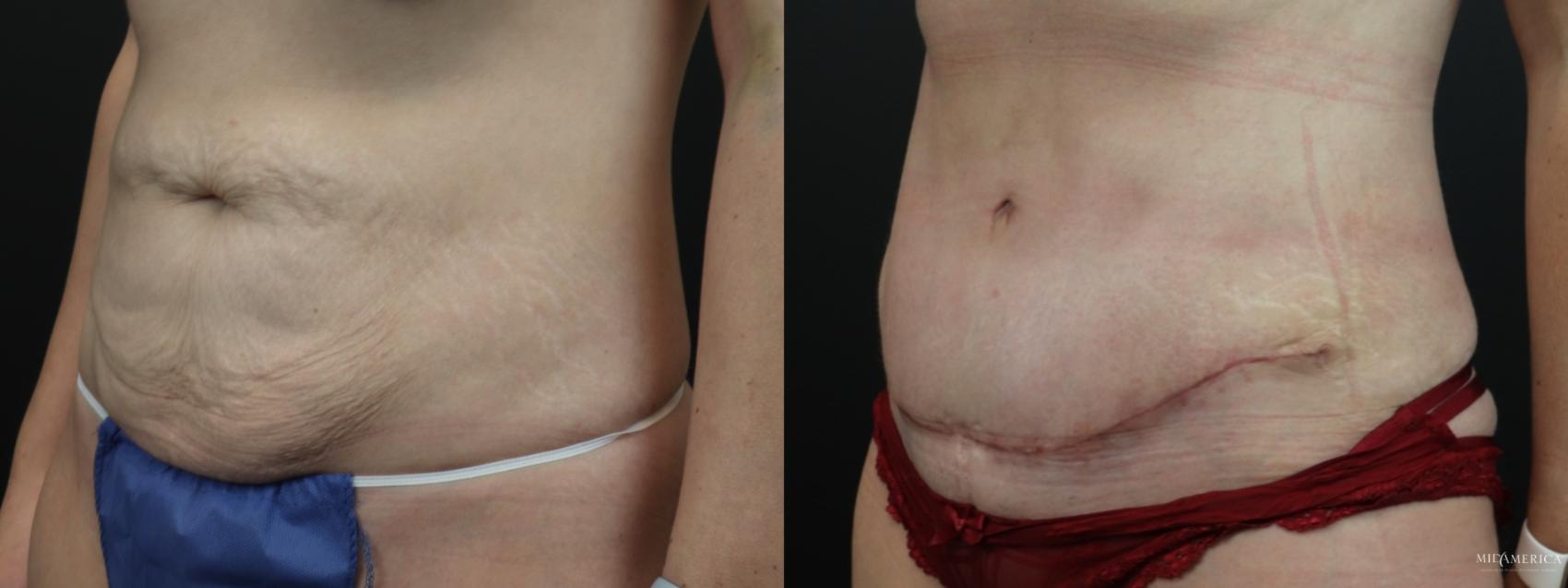 Before & After Tummy Tuck Case 262 Left Oblique View in Glen Carbon, IL